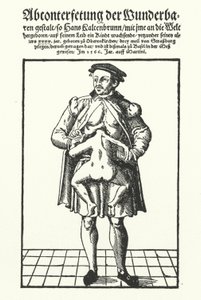 Hans Kaltenbrunn und sein unentwickelter siamesischer Zwilling von German School