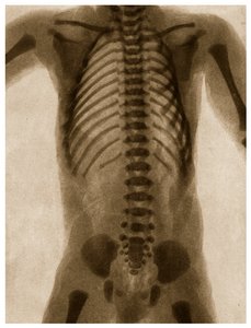Röntgenaufnahme eines menschlichen Torsos von German School