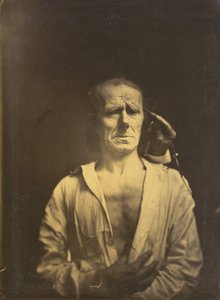 Krampf des M. corrugator supercilii unter sehr starkem Licht (links); Ein entspanntes Gesicht (fotografiert im vollen Sonnenlicht) (rechts)