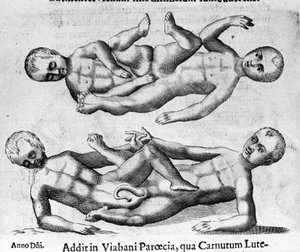 Verschiedene Arten menschlicher Monster: siamesische Kinder, die durch das Becken verbunden sind. Stich aus „De monstrorum natura, causis et differentiis“ von Fortunio Liceti (1577-1656), italienischer Wissenschaftler. 1646 von Italian School