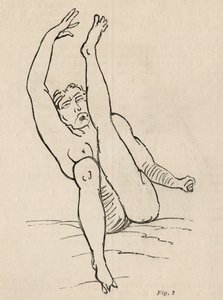 Hysterische Epilepsie, Anfall, Verrenkungen, Abb. 2 aus 