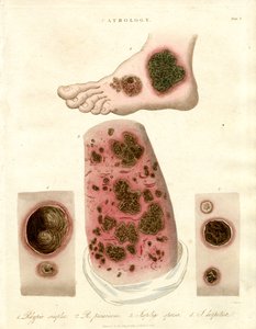 Pathologische Hautzustände - Pityria; Impetigo und Syphilis von John Pass