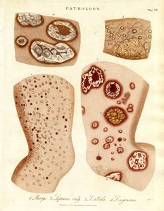 Pathologische Hautzustände: Schurigie; Leprahaut; Pallada und Impetigo von John Pass