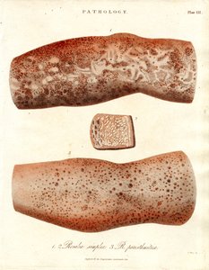 Hautausschläge - Roseola simplex und Roseola paristhmitica von John Pass
