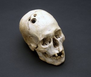 Trepanation Bronzezeitlicher Schädel, Jericho, Palästina, 2200-2000 v. Chr. von Unbekannt Unbekannt