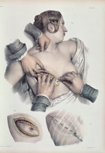Operation eines krebsartigen Tumors, aus 
