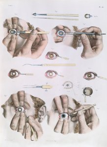 Operation am Auge, Platte aus 