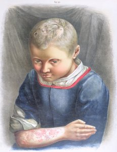 Favus, aus einem Buch von Daniel Cornelius Danielssen (1815-94) 1892