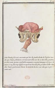 Querschnittsdiagramm eines Babys, das am Arm aus dem Mutterleib gezogen wird, aus einem Buch von Madame Angelique Le Boursier du Coudray, graviert von J. Robert, 1783 von P. Chapparre