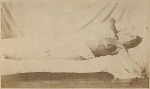 Hysterische Epilepsie, Anfall, Kreuzigung, Tafel VI aus 