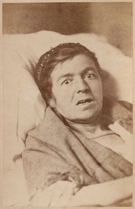 Hysterische Epilepsie, Gesichtskontraktion, Platte VIII aus 