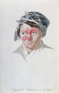 Syphilitische Clusterpusteln, aus einem Buch von Baron Jean Louis Alibert (1768-1837), 1838
