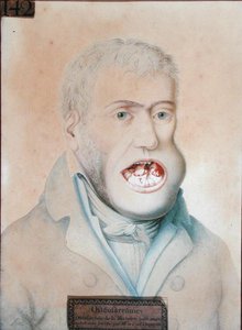 Osteosarkom des Unterkiefers, erfolgreich operiert von Guillaume Dupuytren (1777-1835)