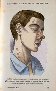 Symptome der tertiären Phase der Syphilis, 19. Jahrhundert von Unbekannt