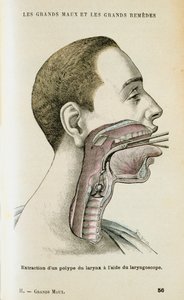 Verwendung eines Laryngoskops zur Entfernung eines Polypen aus dem Hals, ca. 1890 von Unbekannt
