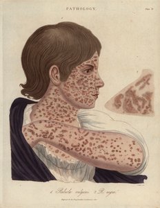 Masern und Röteln - Lithographie von John Pass, veröffentlicht in „Encyclopedia Londinensis“ von John Wilkes, Ausgabe J.Adlard, London