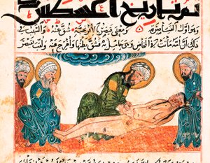 Darstellung eines Kaiserschnitts. Miniatur aus einem medizinischen Manuskript von Abu Raihan Al-Biruni (oder Alberuni) (973-1048), persischer Intellektueller und Wissenschaftler, Folio 161. von Unbekannt