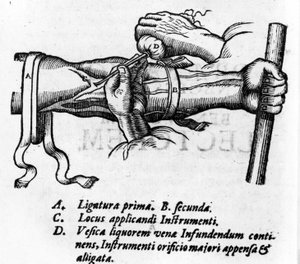 Anatomische Tafel: verschiedene Ligaturen. Arbeit über das Blutsystem von William Harvey (1578-1657), englischer Arzt. Er beschrieb den Blutkreislauf im Körper durch die Vermittlung der Venen