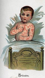 Kinderkrankheiten: Nesselsucht. In „Die neue Naturmedizin“ von F.E. Bilz. von Unknown artist