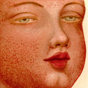Eruptive Fieber: Scharlachfieber von Unknown artist