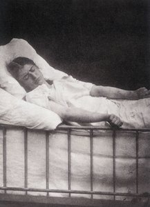 Hystero-Epilepsie - Tetanismus-Anfall in „Photographische Ikonographie der Salpêtrière: Dienst von Herrn Charcot“ von Paul Regnard und Bourneville von Unknown artist