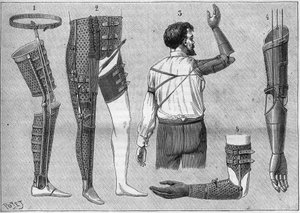 Moderne Apparate für Amputierte. 1) Künstliches Bein mit Gürtel, 2) Apparat für die Oberschenkelgelenke, 3 und 4 künstliche Arme, erfunden und gebaut von M.L Matthieu für den verstorbenen Roger, 5) künstlicher Arm mit Hand, Daumen und Zeigefinger. In „La n