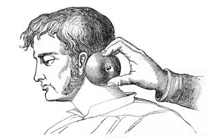 Lokale Blutegelbehandlung - Anwendung von Blutegeln mit einem Apfel - Gravur in „La Santé Universelle - Guide Médical des Familles“ 1852 von Unknown artist