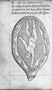 Die Position des Fötus in der Gebärmutter während der Schwangerschaft. Gravur aus „De la generation des enfants“ von Ambroise Paré (1509-1590) 16. Jahrhundert