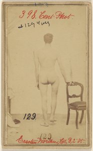 Bruch des oberen Drittels des Oberschenkelknochens. Erastus Worthen, Corp Co. B. 2. Vermont Vols. Alter 25 - Wohnort Stockbridge VT. von Unknown artist