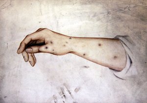 Studie eines Unterarms mit Hauterkrankung, ca. 1850 von William Lover