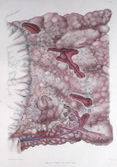 Krebs des Epiploons, aus 
