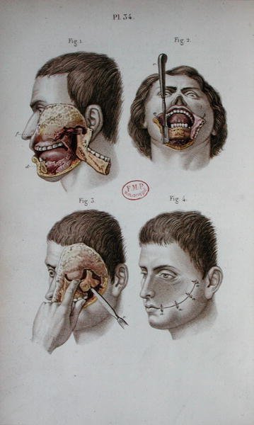 Anatomische Platte des Oberkiefers von C and Huette E. Bernard