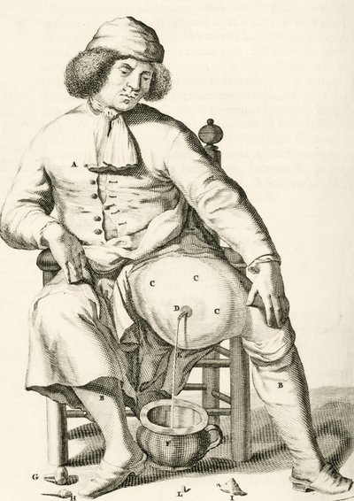 Abfluss von Flüssigkeit aus einem Abszess, aus Exercitationes Practicae circa Medendi Methodum von Frederik Dekkers, 1694 von Dutch School