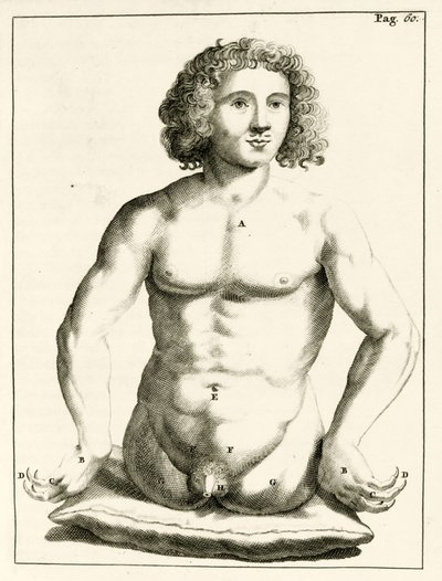 Beispiel für angeborene Geburtsfehler, aus Exercitationes Practicae circa Medendi Methodum von Frederik Dekkers, 1694 von Dutch School