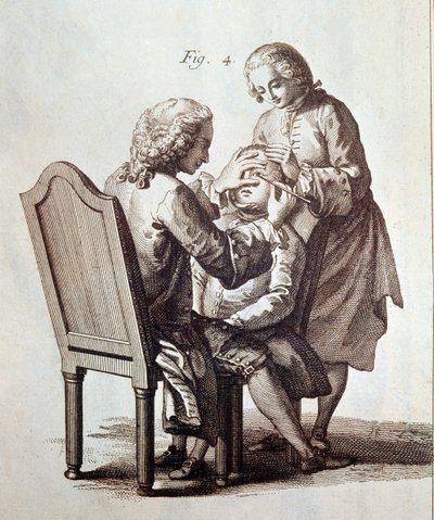 Ein Arzt operiert einen Katarakt-Patienten, Illustration aus der Medizinischen Enzyklopädie von Denis Diderot und Jean le Rond d