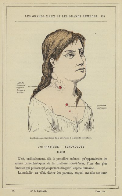 Charakteristische Unfälle der Skrofulose in der Sekundärperiode von French School