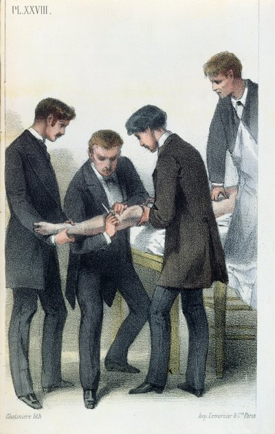 Amputation eines Arms, aus einem medizinischen Handbuch von Jean-Baptiste-Leon Dubreuil, ca. 1850-60 von French School
