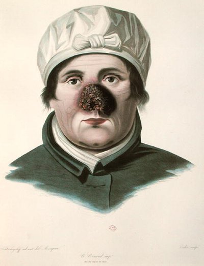 Vor einer Hauttransplantation, aus 