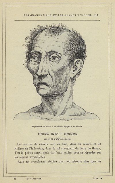 Gesichtsausdruck eines Kranken in der asphyktischen Phase der Cholera von French School