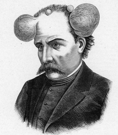 Darstellung einer Person mit Lupe, Kopfzysten (Gravur) von French School