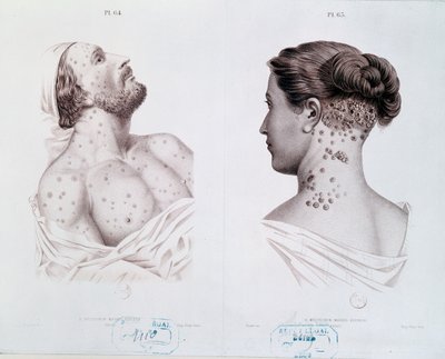 Symptome der Syphilis bei Männern und Frauen, aus einem medizinischen Buch, ca. 1850-60 von French School