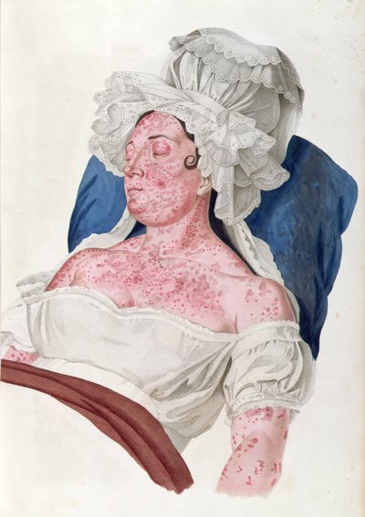 Frau mit Scharlach, aus einem Buch von Baron Jean Louis Alibert (1768-1837) graviert von Choupard, 1833 von French School