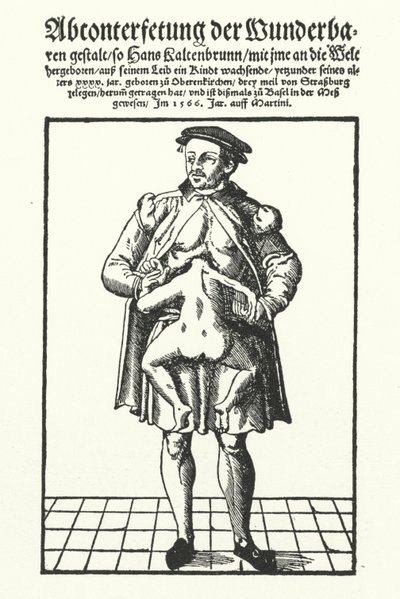 Hans Kaltenbrunn und sein unentwickelter siamesischer Zwilling von German School