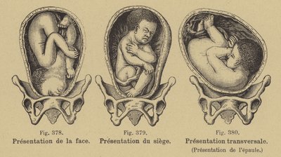 Fehllage von Babys im Mutterleib vor der Geburt von German School