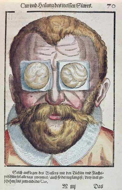 Behandlung einer Augenkrankheit, aus Ophthalmodouleia von Georg Bartisch (1535-1636) veröffentlicht in Dresden 1583 (Farbholzschnitt) von German School