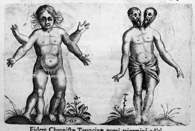 Verschiedene Arten von menschlichen Monstern. Gravur aus „De monstrorum natura, causis et differentiis“ von Fortunio Liceti (1577-1656), italienischer Wissenschaftler. 1646 von Italian School