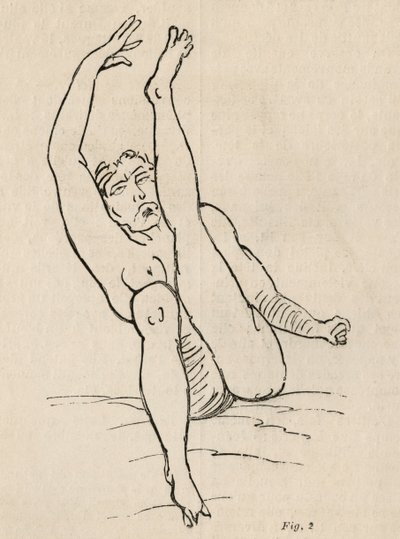 Hysterische Epilepsie, Anfall, Verrenkungen, Abb. 2 aus 