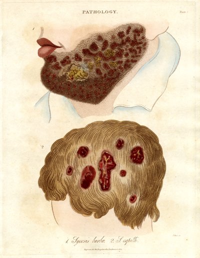 Pathologische Illustration von Sycosis barbae und Sycosis capilli von John Pass