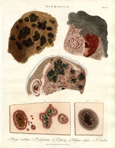Pathologische Hautveränderungen: Porriga und Ecthyma von John Pass