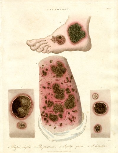Pathologische Hautzustände - Pityria; Impetigo und Syphilis von John Pass